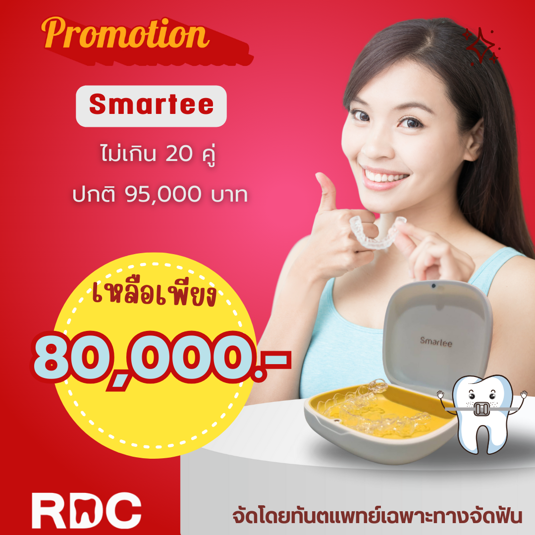 โปรโมชัน Smartee ไม่เกิน 20 คู่